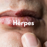 Herpes